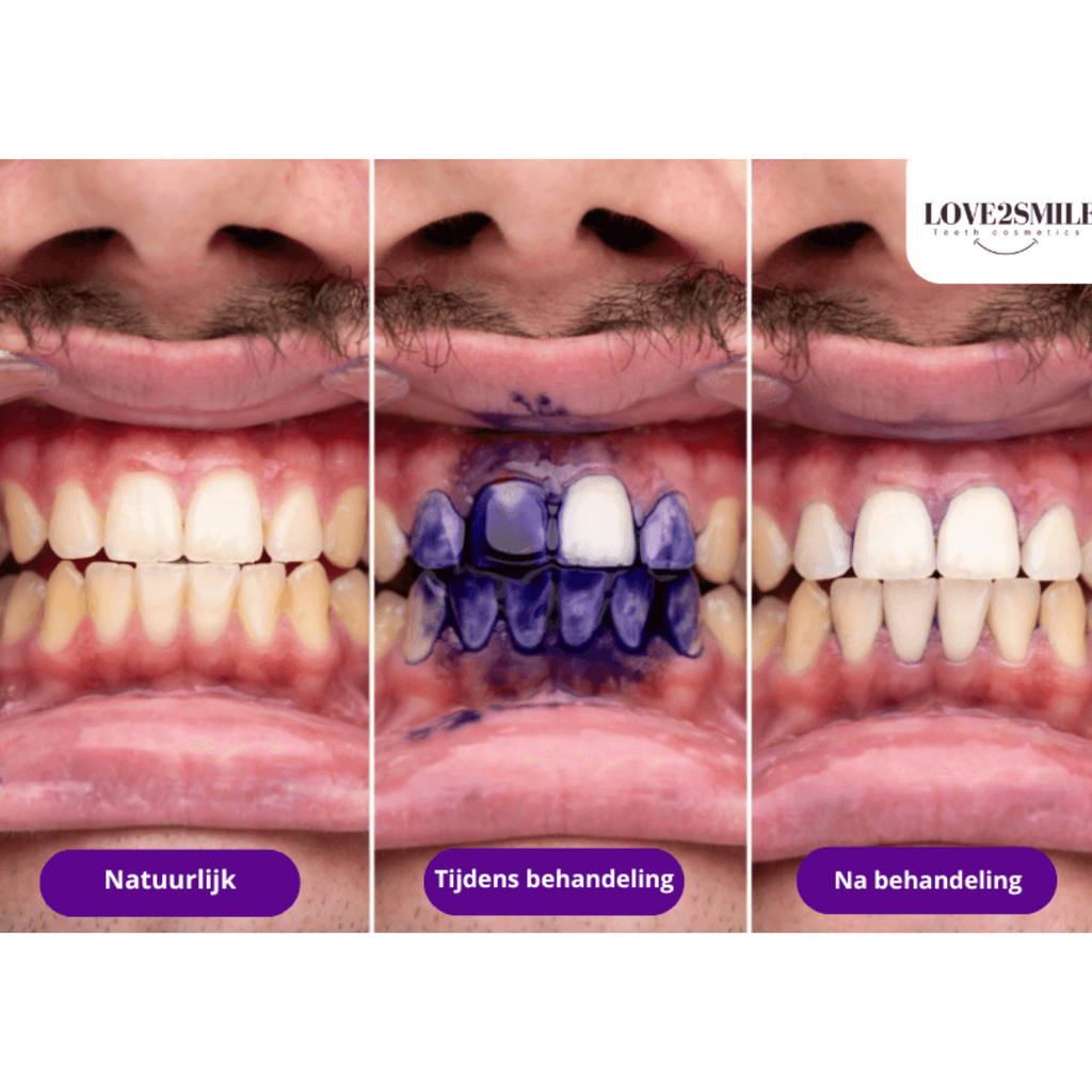 Ultimate Teeth Whitening Bundle - PAP+ Strips + Purple Shampoo | Complete Kit